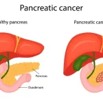 Pankreas Kanseri Nedir? Belirtileri Nelerdir?