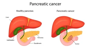 Pankreas Kanseri Nedir? Belirtileri Nelerdir?