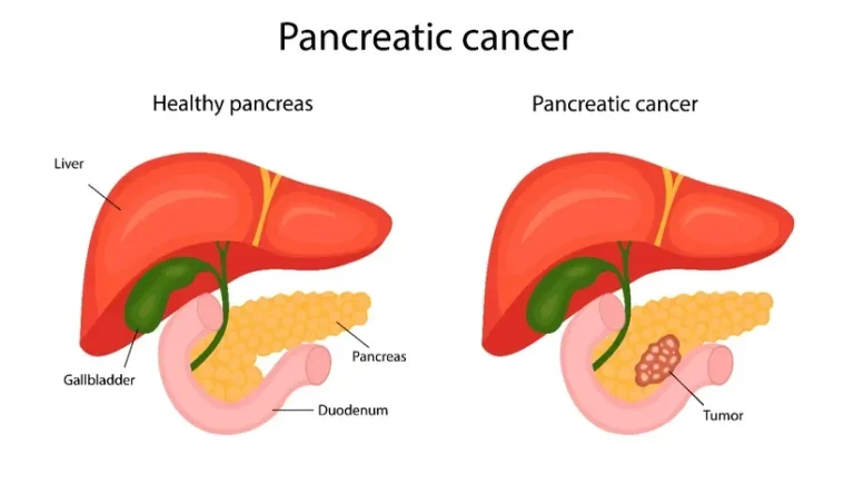 Pankreas Kanseri Nedir? Belirtileri Nelerdir?